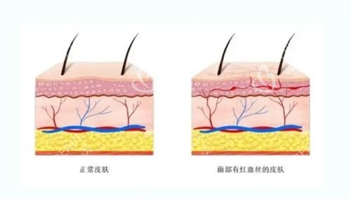 红血丝的皮肤和正常皮肤的对比