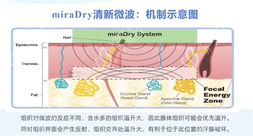 miraDry清新微波机制示意图