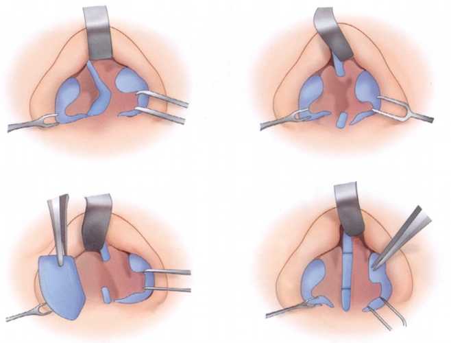 歪鼻矫正手术 歪鼻矫正手术