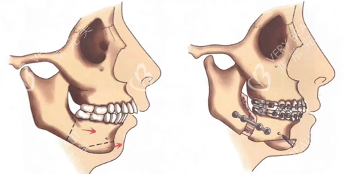 正頜手術(shù)前后圖