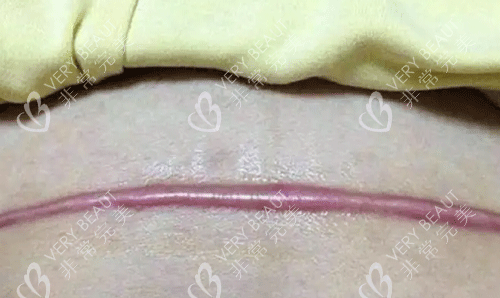 疤痕增生 疤痕增生