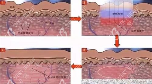 光子嫩膚的步驟
