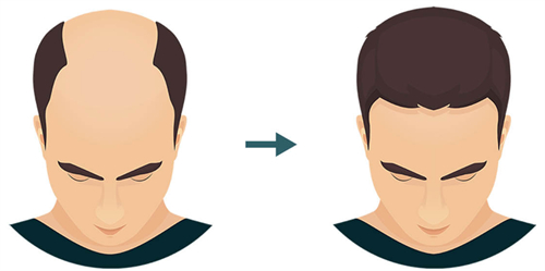 植發(fā)前后對(duì)比圖