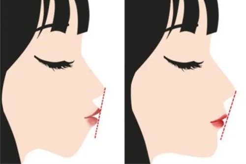 正頜手術(shù)前后的對比圖