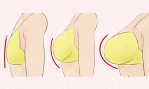 隆胸尺寸對比 隆胸尺寸對比