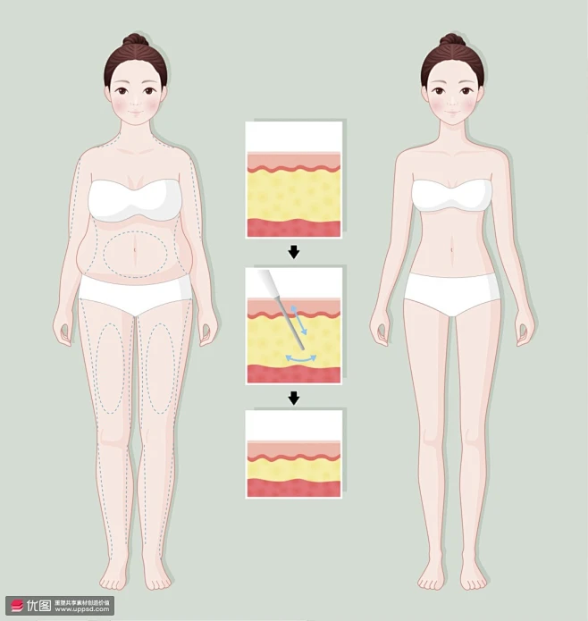 全身吸脂手術(shù) 全身吸脂手術(shù)