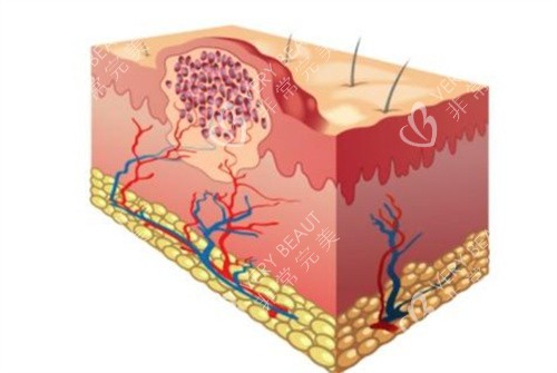 疤痕疙瘩 疤痕疙瘩