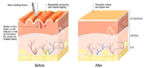 凹陷疤痕填充前后对比图 凹陷疤痕填充前后对比图