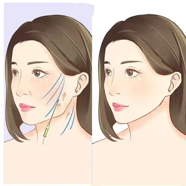 拉皮除皺手術(shù)