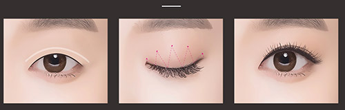 埋線雙眼皮過程示意圖