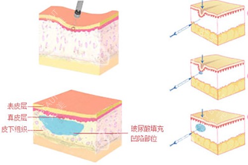 玻尿酸填充皮下组织示意图 玻尿酸填充皮下组织示意图