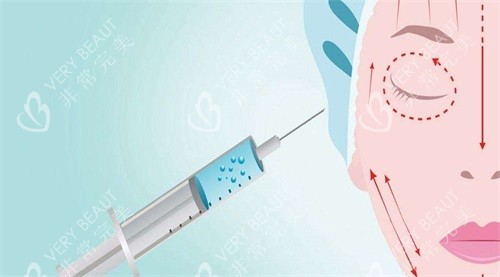 注射玻尿酸示意图 注射玻尿酸示意图