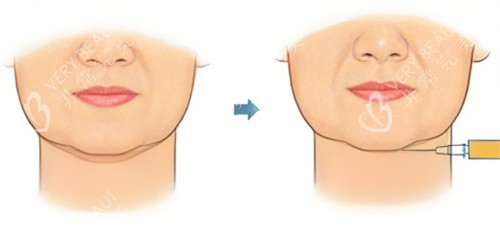 双下巴注射示图 双下巴注射示图
