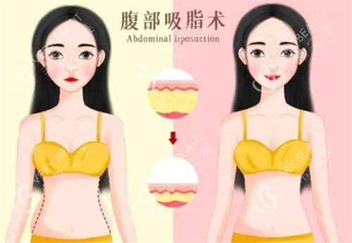 吸脂前后对比