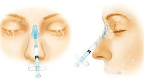 玻尿酸注射隆鼻动画展示图
