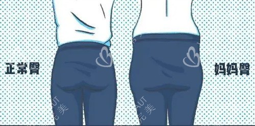 正常臀部和妈妈臀对比动画图 正常臀部和妈妈臀对比动画图