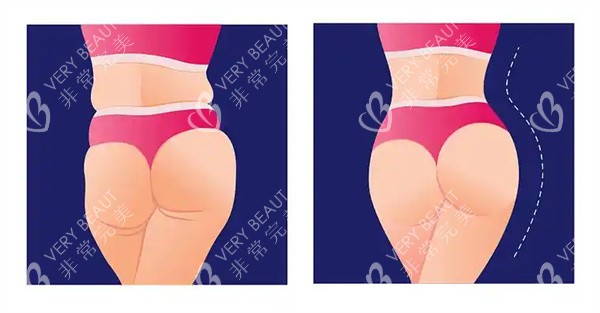 臀部脂肪填充 臀部脂肪填充