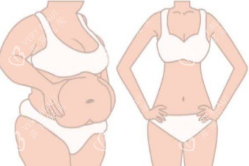 吸脂塑形前后对比图 吸脂塑形前后对比图