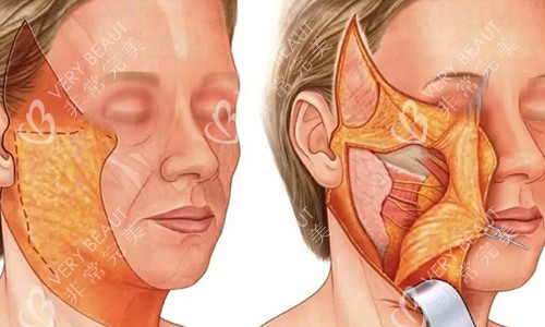 拉皮手术过程动画示意图 拉皮手术过程动画示意图