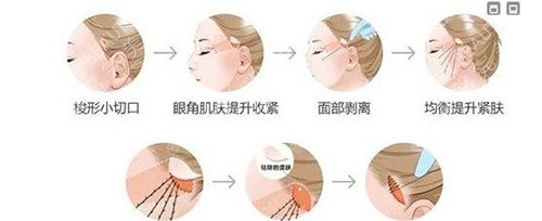 小切口拉皮 小切口拉皮