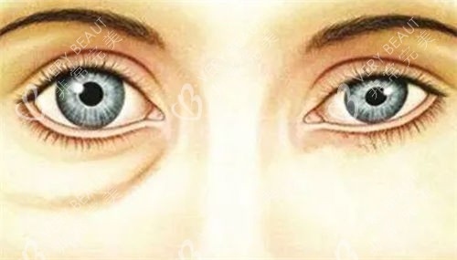 假性眼袋对比展示图 假性眼袋对比展示图