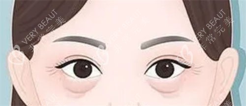 眼袋松弛和泪沟细纹展示图 眼袋松弛和泪沟细纹展示图