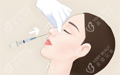 注射隆鼻 注射隆鼻