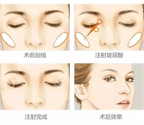 玻尿酸前后注射示意图 玻尿酸前后注射示意图