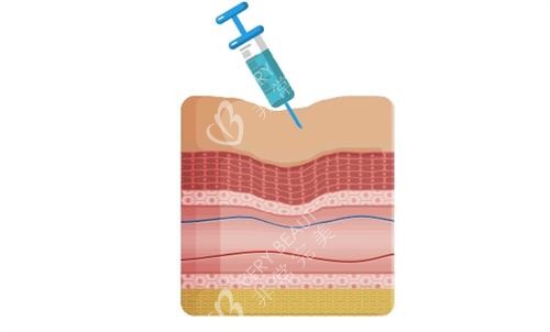 Juvelook素颜针注射示意图 Juvelook素颜针注射示意图