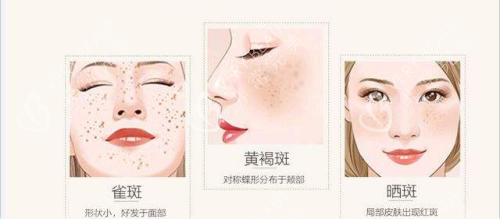 激光祛斑 激光祛斑