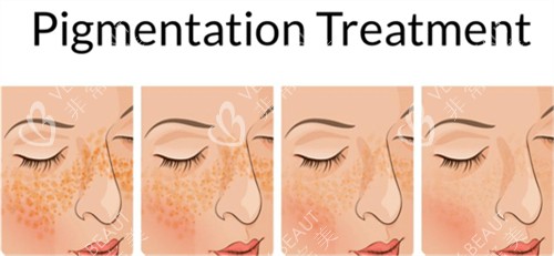 激光祛斑前后皮肤对比 激光祛斑前后皮肤对比