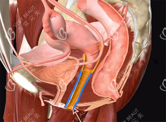 阴道紧缩针动画原理 阴道紧缩针动画原理