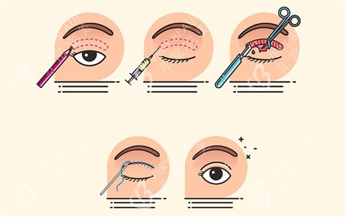 埋线双眼皮过程卡通图 埋线双眼皮过程卡通图