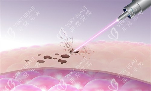 激光祛斑原理图 激光祛斑原理图