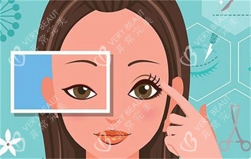 双眼皮手术前后对比 双眼皮手术前后对比