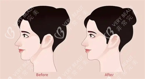 双下巴对比 双下巴对比