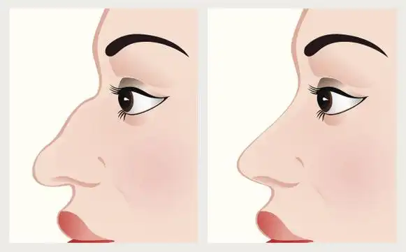 驼峰鼻矫正术 驼峰鼻矫正术