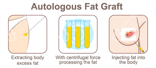 自体脂肪隆胸手术过程 自体脂肪隆胸手术过程