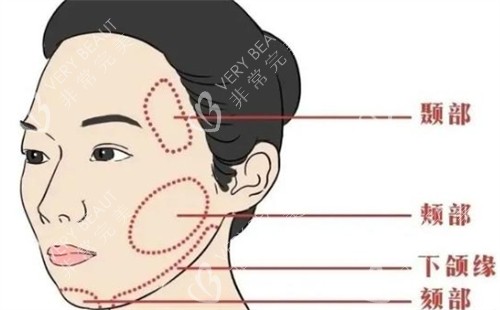 面部提升可以提升的区域 面部提升可以提升的区域