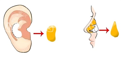 隆鼻耳软骨图示 隆鼻耳软骨图示