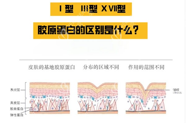 胶原蛋白一型和三型对比区别 胶原蛋白一型和三型对比区别