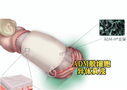 阴茎生物补片ADM材料是什么 阴茎生物补片ADM材料是什么