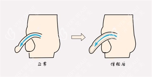 增粗术前后对比 增粗术前后对比