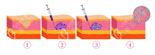 乔雅登HarmonyCA天使针注射变化 乔雅登HarmonyCA天使针注射变化