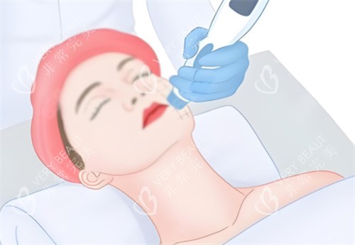 面部热玛吉 面部热玛吉