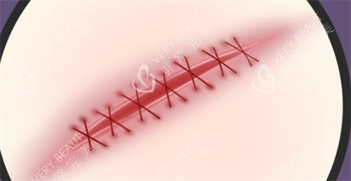 手术疤痕 手术疤痕