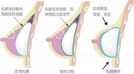 假体隆胸包膜挛缩 假体隆胸包膜挛缩