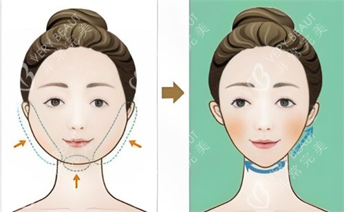 面部吸脂对比卡通 面部吸脂对比卡通