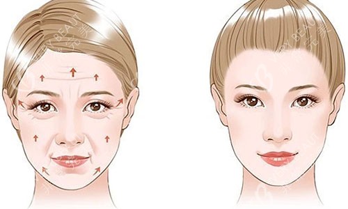 拉皮手术前后对比图 拉皮手术前后对比图