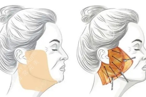 筋膜悬吊提升术卡通图 筋膜悬吊提升术卡通图